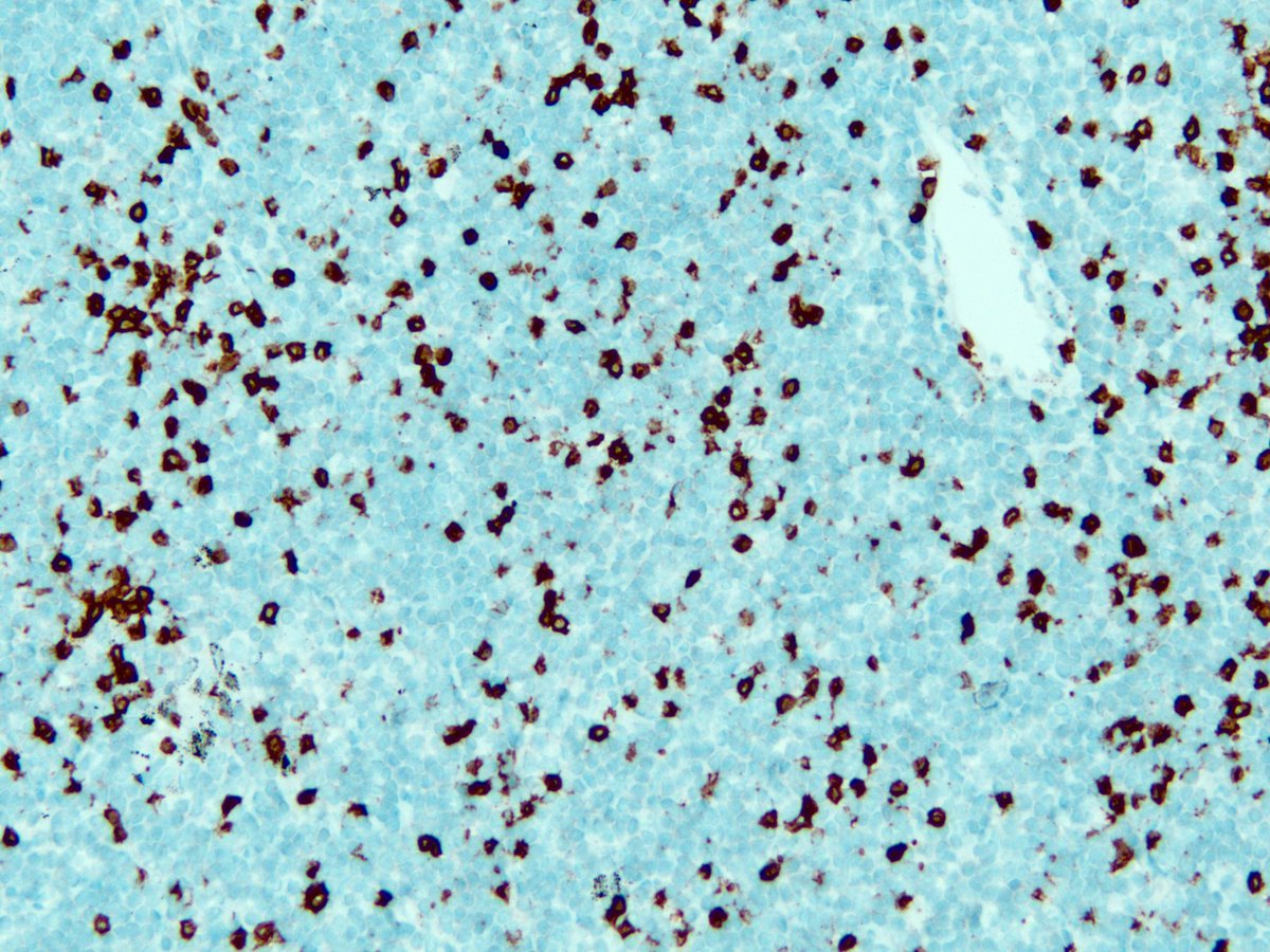 smlungpathguy's tweet photo. I promised @evemariecrane a long time back I would post this: LEF1 in CLL. Other IHCs are CD3 and CD20 @mvmd0908 @pembeoltulu @JL_Sauter https://t.co/UEHnGThtHt