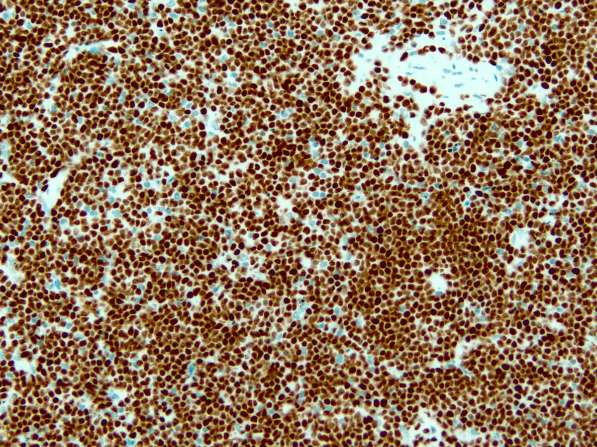 smlungpathguy's tweet photo. I promised @evemariecrane a long time back I would post this: LEF1 in CLL. Other IHCs are CD3 and CD20 @mvmd0908 @pembeoltulu @JL_Sauter https://t.co/UEHnGThtHt