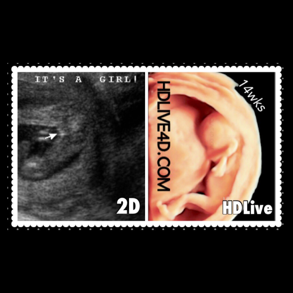 3Dand4Dtech's tweet photo. #Gender #ultrasound #3D4D #HDLive4D #pregnancy #expecting #motherhood #maternity #baby #Fairfax #NoVa #Loudoun #14weeks #20weeks #28weeks https://t.co/96LhHgFMOj