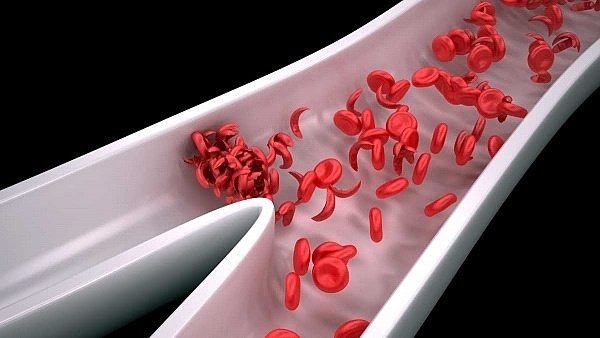 WatchtowerKitui's tweet photo. Understanding sickle cell disease
https://t.co/mJl29FtzN6
#TheWatchTower_Kitui https://t.co/cc222ZkEXA