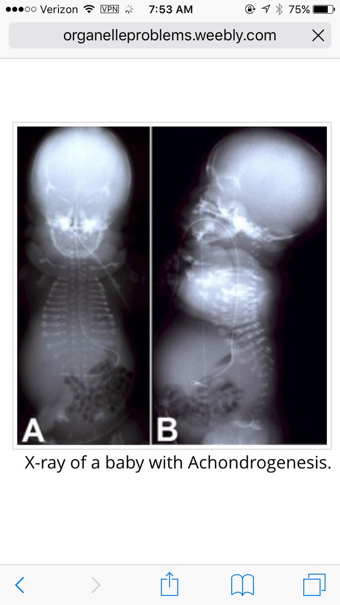 we_the_membrane's tweet photo. @golgiproject1 the Golgi body causes achondrogenesis which affects bone development! Protect your babies! #euKArya2016 https://t.co/kirPgk2Hlq