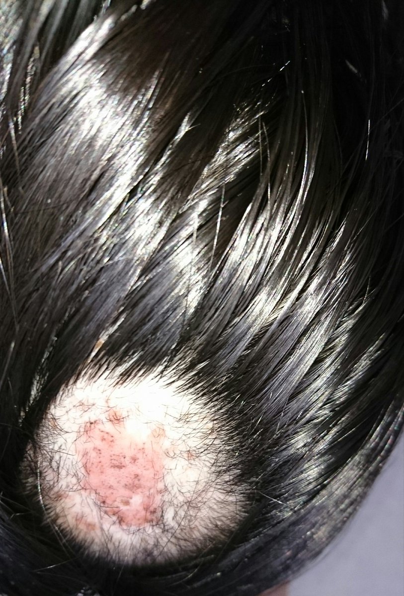 ট ইট র 脱抜毛症２ 傷周りの毛が長くなってきた でも 傷口は全然生えない そして 左上小さい傷があるところ禿げ始めてる