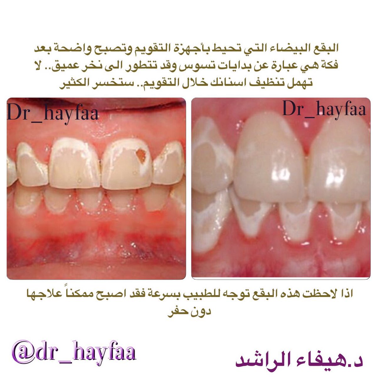 د هيفاء حمد الراشد On Twitter البقع البيضاء او التسوسات البيضاء