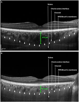 FrontEndocrinol's tweet photo. Choroidal and Retinal Abnormalities by Optical Coherence Tomography in Endogenous Cushing’s Syndrome: Maria… https://t.co/CccG2ozXuc https://t.co/9aPFLxNUkp