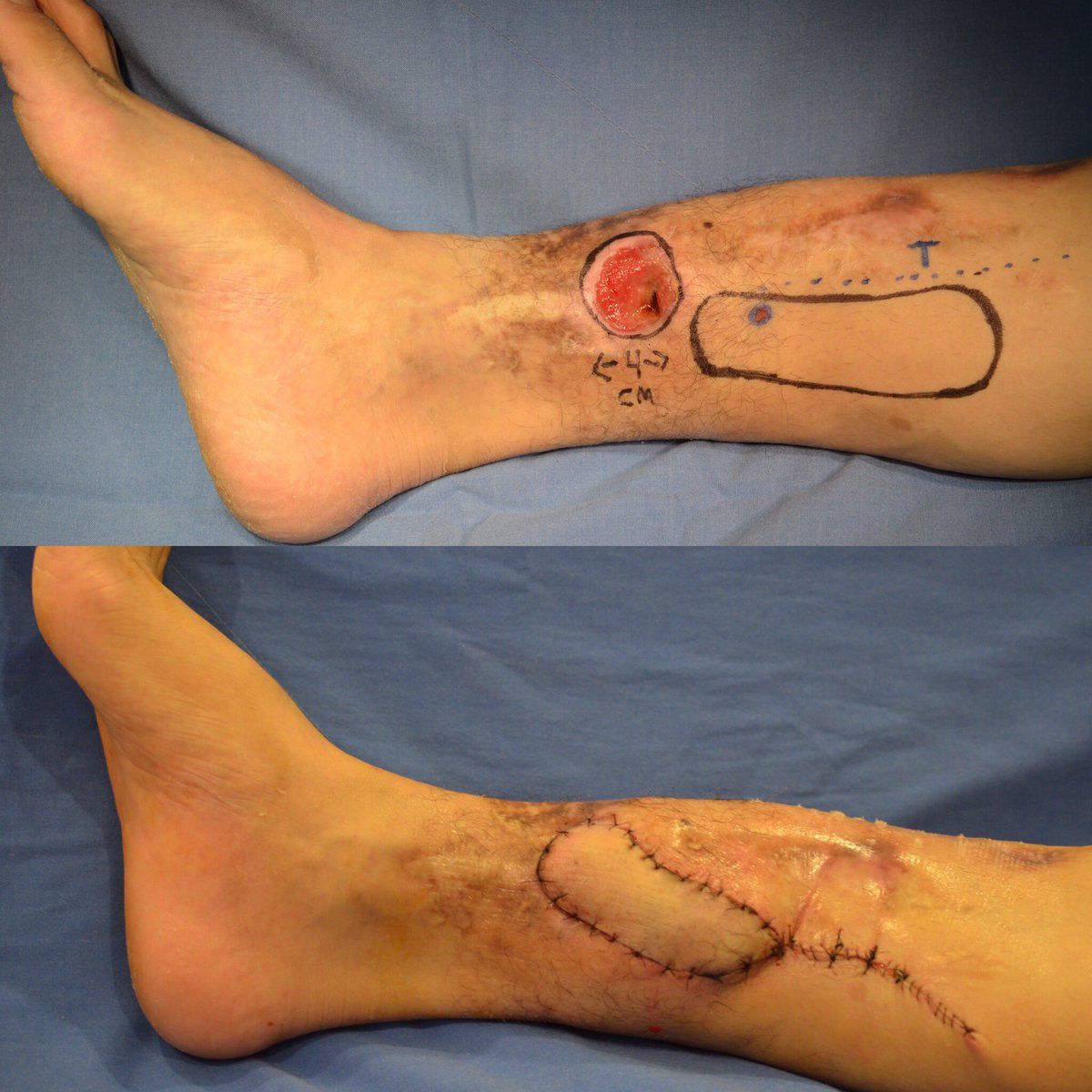 MendietaAesthet's tweet photo. Propeller flap, 72 hrs postop. One of our favorites procedures for small-medium defects coverage in lower extremity . #perforatorflaps https://t.co/tchF8pRcXw