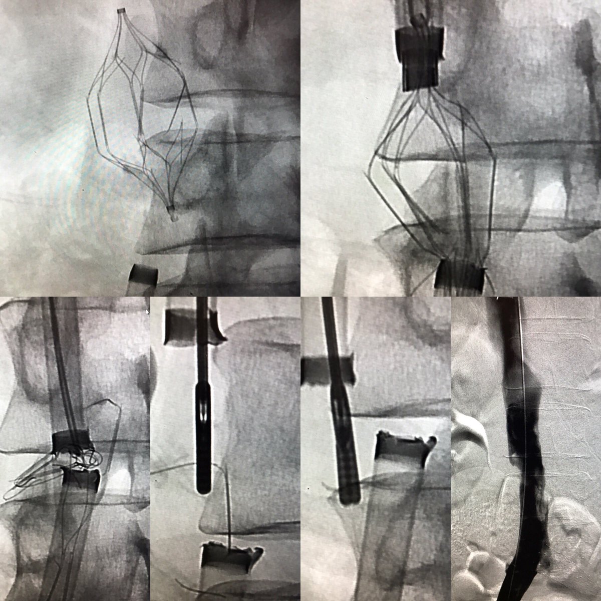 kush_r_desai's tweet photo. 13 yo fractured OptEase that's low, caused DVTx3; #filterOUT with "laser" and #fragOUT with forceps @NorthwesternIR @JVIRmedia @EVToday https://t.co/tEuf2TDLFx