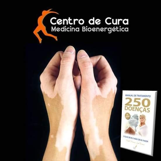 #vitiligo #tratamento #centrodecura #manualdetratamento250doencas