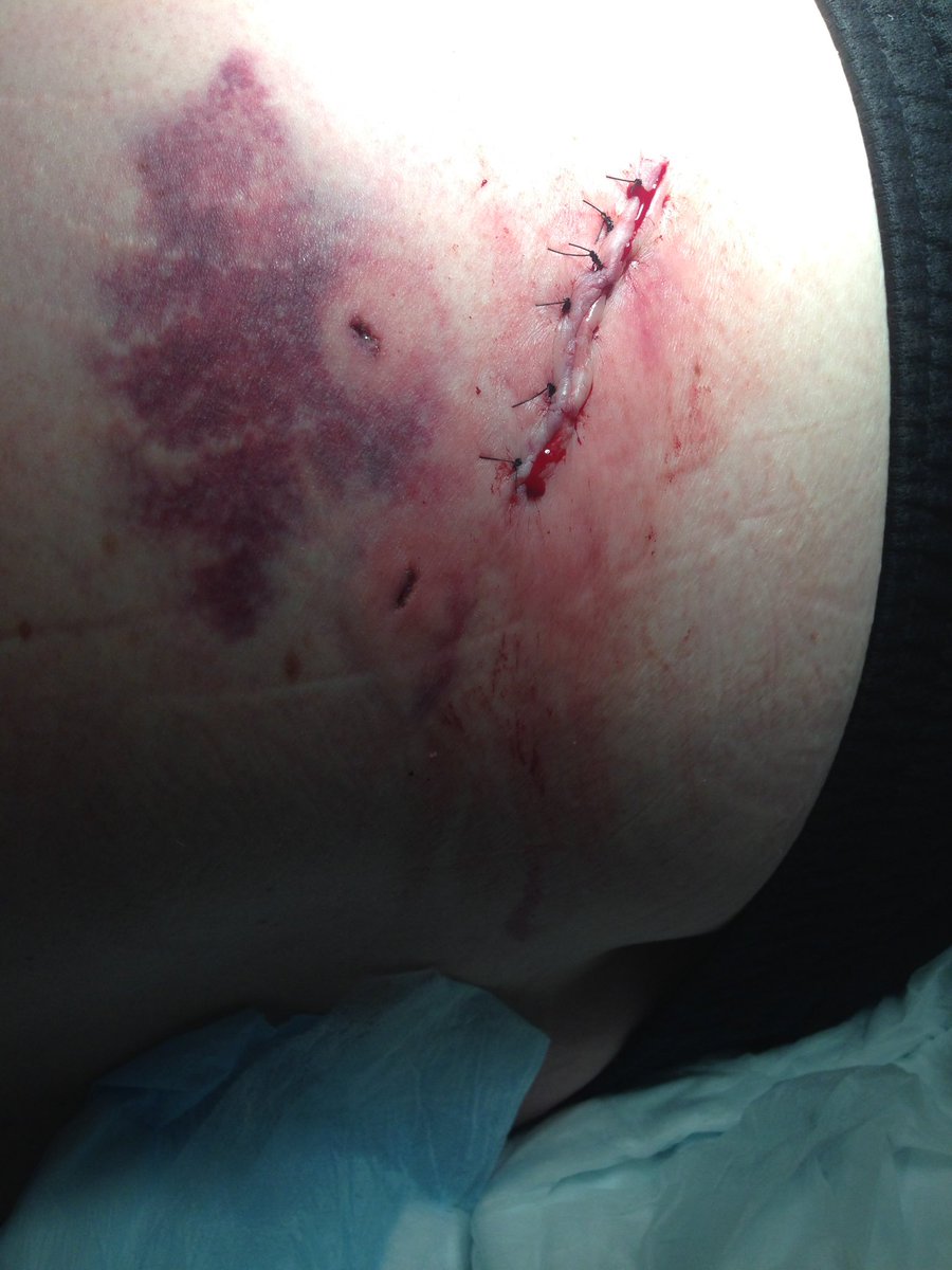 EdwardATS's tweet photo. Busted rear rib cage and a 3" long and 1/2" deep cut...bed rest for me. #norcos #bed #pizza #cannabis #painkiller #ouchie https://t.co/0ouyztjc4x