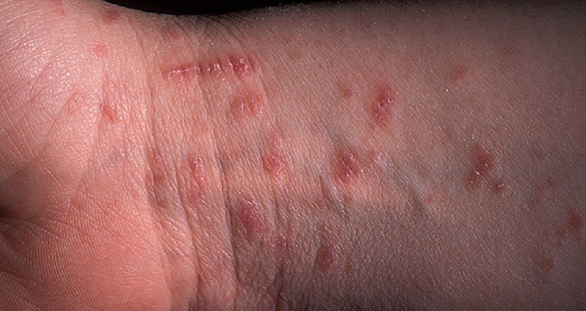 Webmd On Twitter In Its Early Stages Scabies May Be Mistaken
