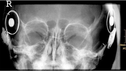Acoustic neuroma. Pemeriksaan X-Ray biasanya dilakukan dalam posisi Towne atau Stenver. Didapatkan gambaran cerebellopontine-angle tumor.