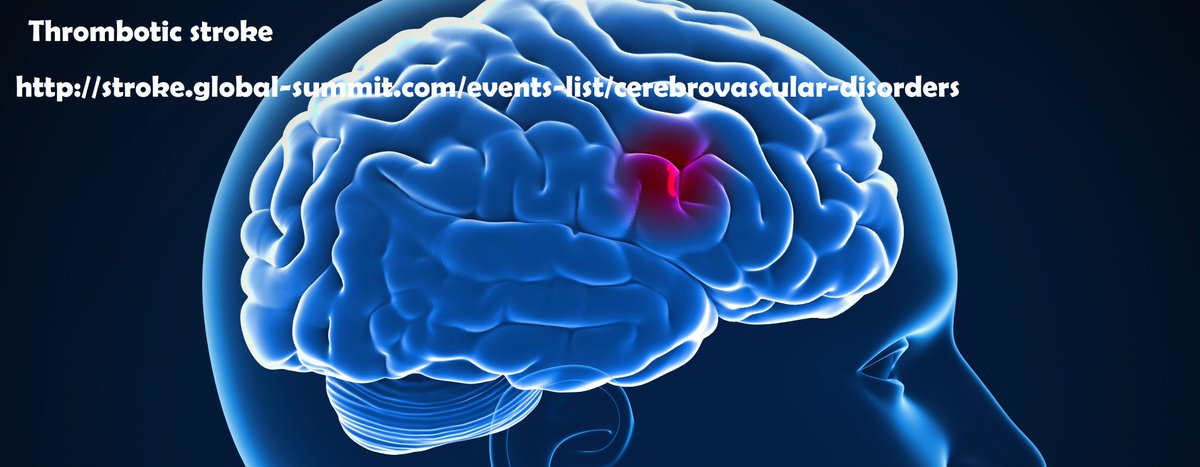 Stroke_2019's tweet photo. #Embolicstroke
A blockage of blood supply to part of the #brain caused by a clot or debris #embolus
#neurologymeetdubai #fightstrokedubai https://t.co/ni86LmfWwa
