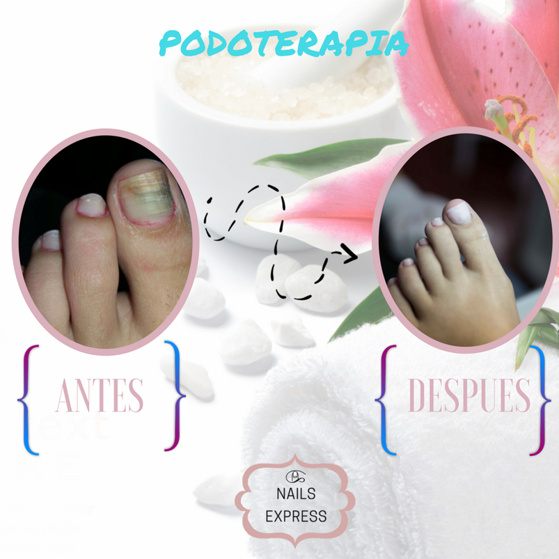 NAILSEXPRESSBY1's tweet photo. Observá el ANTES y el DESPUÉS de la uña que fue tratada de micosis mediante una estrategia no invasiva y de rápida recuperación
#Podoterapia https://t.co/SyG9ArEmpV