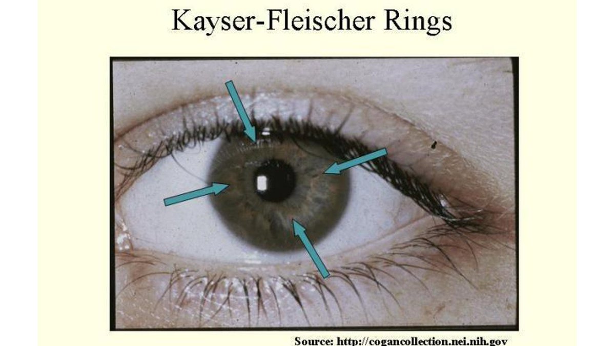 Wilson's Disease. Autosomal resesif, penumpukan tembaga dlm tubuh. Klinis: gg. hepar, chorea, ataxia, Kayser-Fleischer Rings pd kornea.