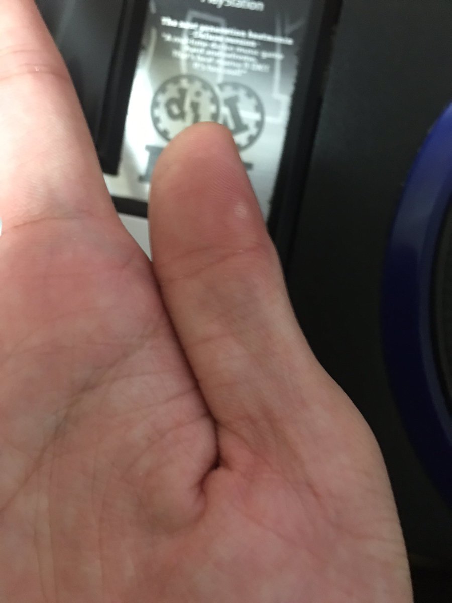 お米ぜろ 水ぶくれの場所でボタン押すたびになんともいえない痛みが襲ってきます ヮ