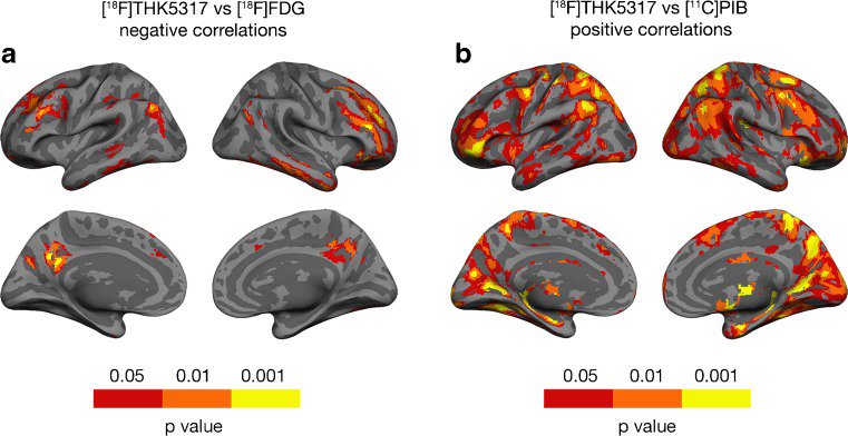 ahier's tweet image. 1st in-human #clinicaltrial targeting #Alzheimer&apos;s tau protein looks promising bit.ly/2hs7oEZ
#neuralimaging #neuroscience #biomed