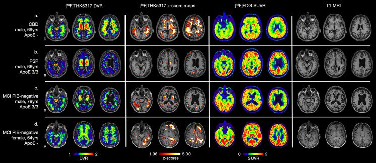 ahier's tweet image. 1st in-human #clinicaltrial targeting #Alzheimer&apos;s tau protein looks promising bit.ly/2hs7oEZ
#neuralimaging #neuroscience #biomed