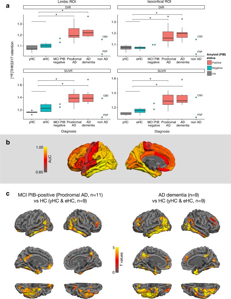 ahier's tweet image. 1st in-human #clinicaltrial targeting #Alzheimer&apos;s tau protein looks promising bit.ly/2hs7oEZ
#neuralimaging #neuroscience #biomed