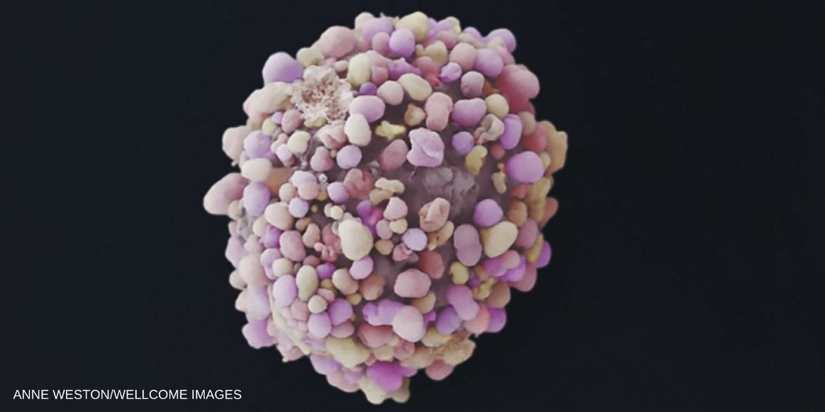 Cancer cells spread way earlier than thought, seeding metastases that cause most deaths bit.ly/2hwfTvZ