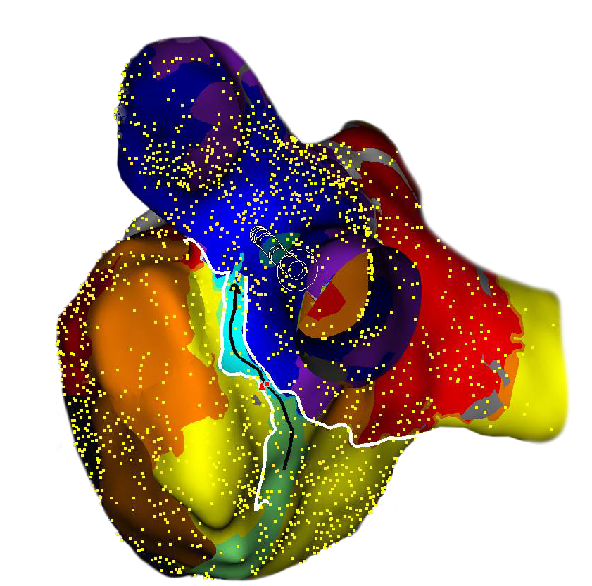 .@StJudeMedical announces FDA clearance of EnSite Precision #Cardiac Mapping System. #Arrhythmias News: bit.ly/2hRBaj4