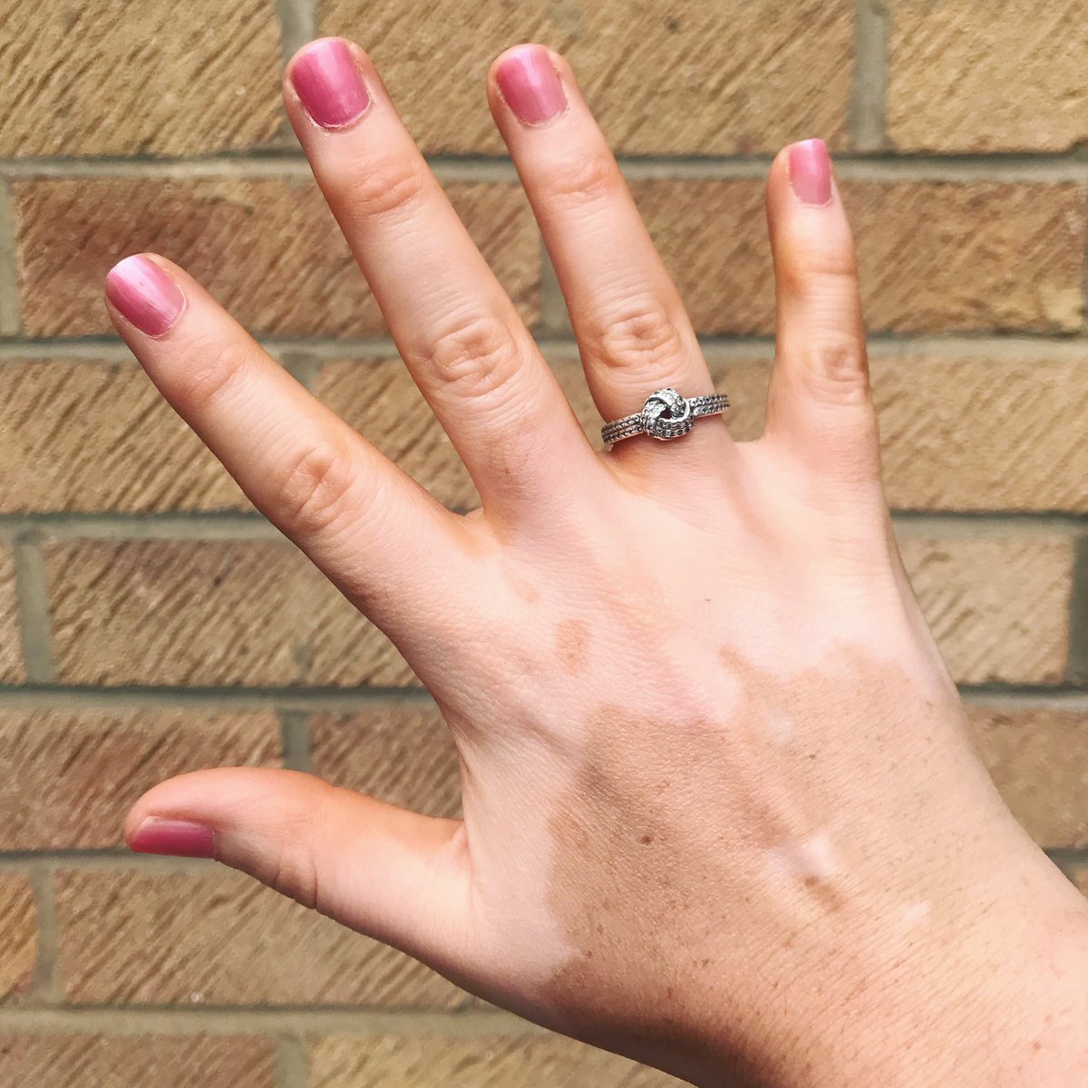 Who has #vitiligo? 

Show us a hand 🖐

Let’s keep spreading awareness 👇