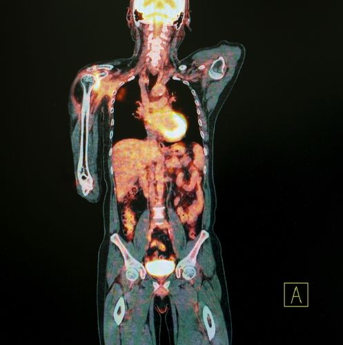NewsProstate's tweet photo. New Post: 68Ga-PSMA-11 Better than Axumin at Detecting PC Recurrence, Trial Shows https://t.co/4F4XecNwxU https://t.co/o3fo4RcVse