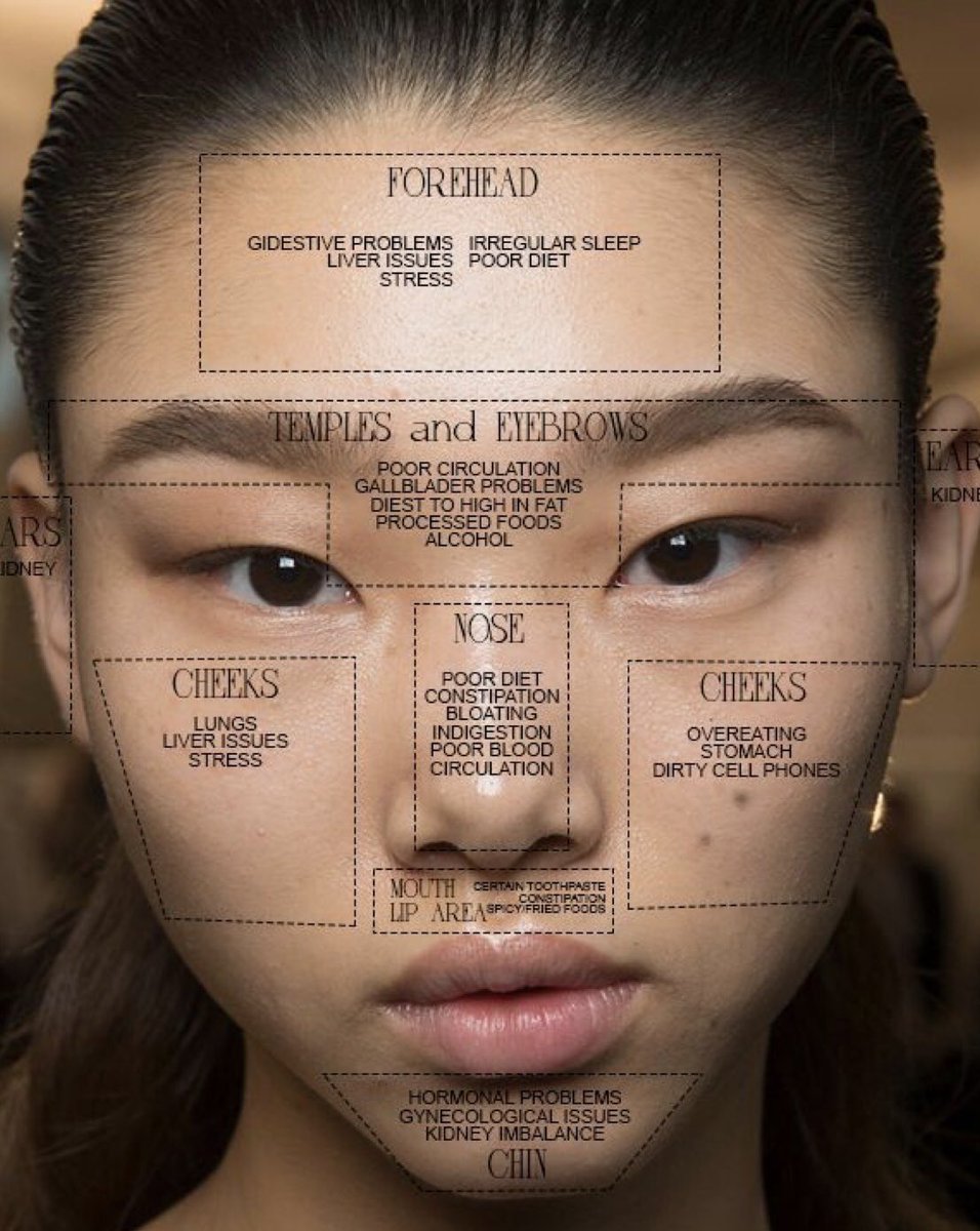 Acne Location Chart