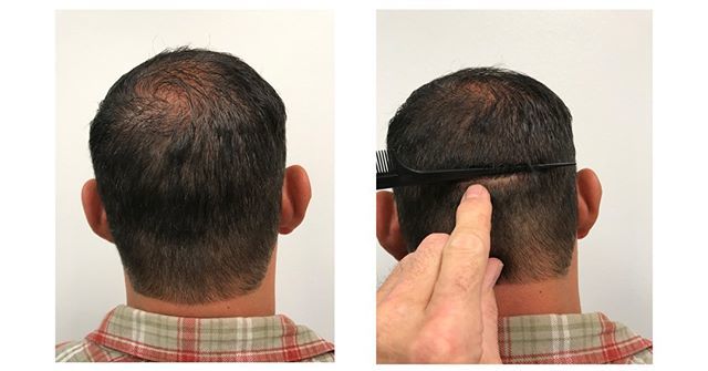 JLWilliamsMD's tweet photo. Totally undetectable! Dr. Williams is the best in the business. He promises a natural look and minimal scaring. 
We also offer virtual consults with Dr. Williams himself!
Call today (888)357-0888
*
*
*
*
 #hairtransplant #hairrestoration #hairloss #prp #fue #growhair #boardc… https://t.co/glT8K6dV7y