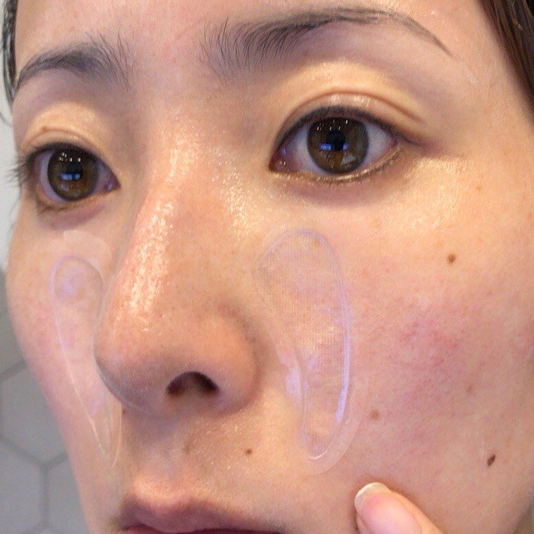 毛穴ケア目元ケア！ずっと使ってるヒアルロン美容鍼ナビジョンHAフィルパッチ！最近おすすめの使い方 pyonkobeauty.com/?p=8276