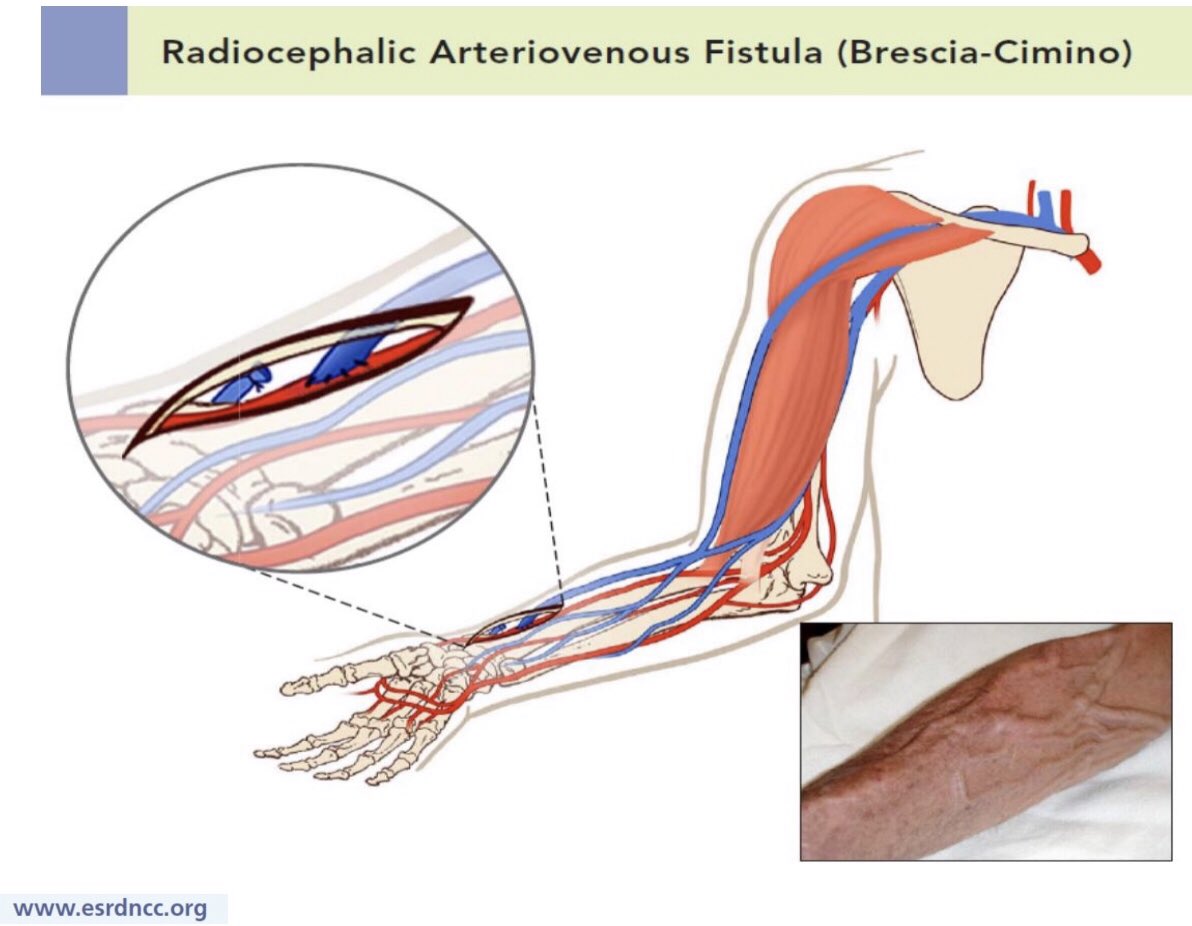 Артериовенозный шунт. Артерия венозная фистула. Артериовенозная фистула для гемодиализа.