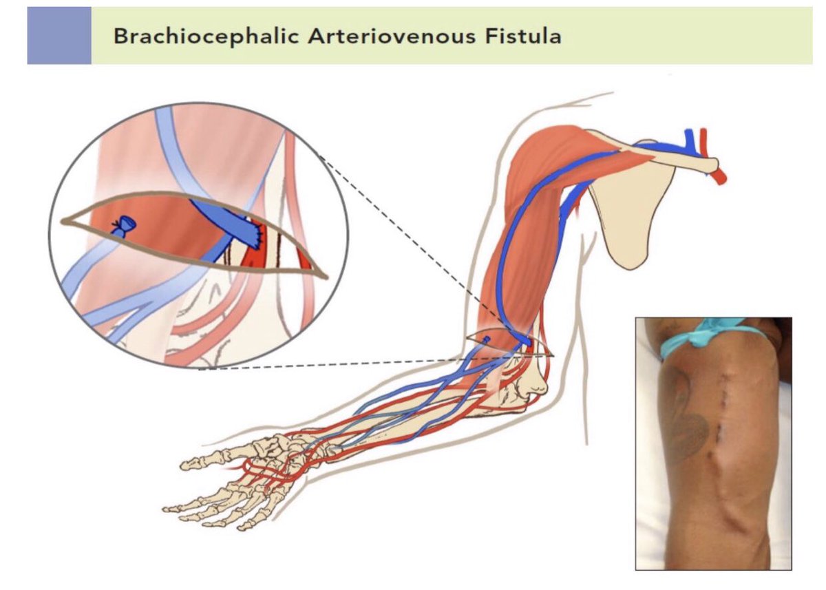brachial cephalic fistula