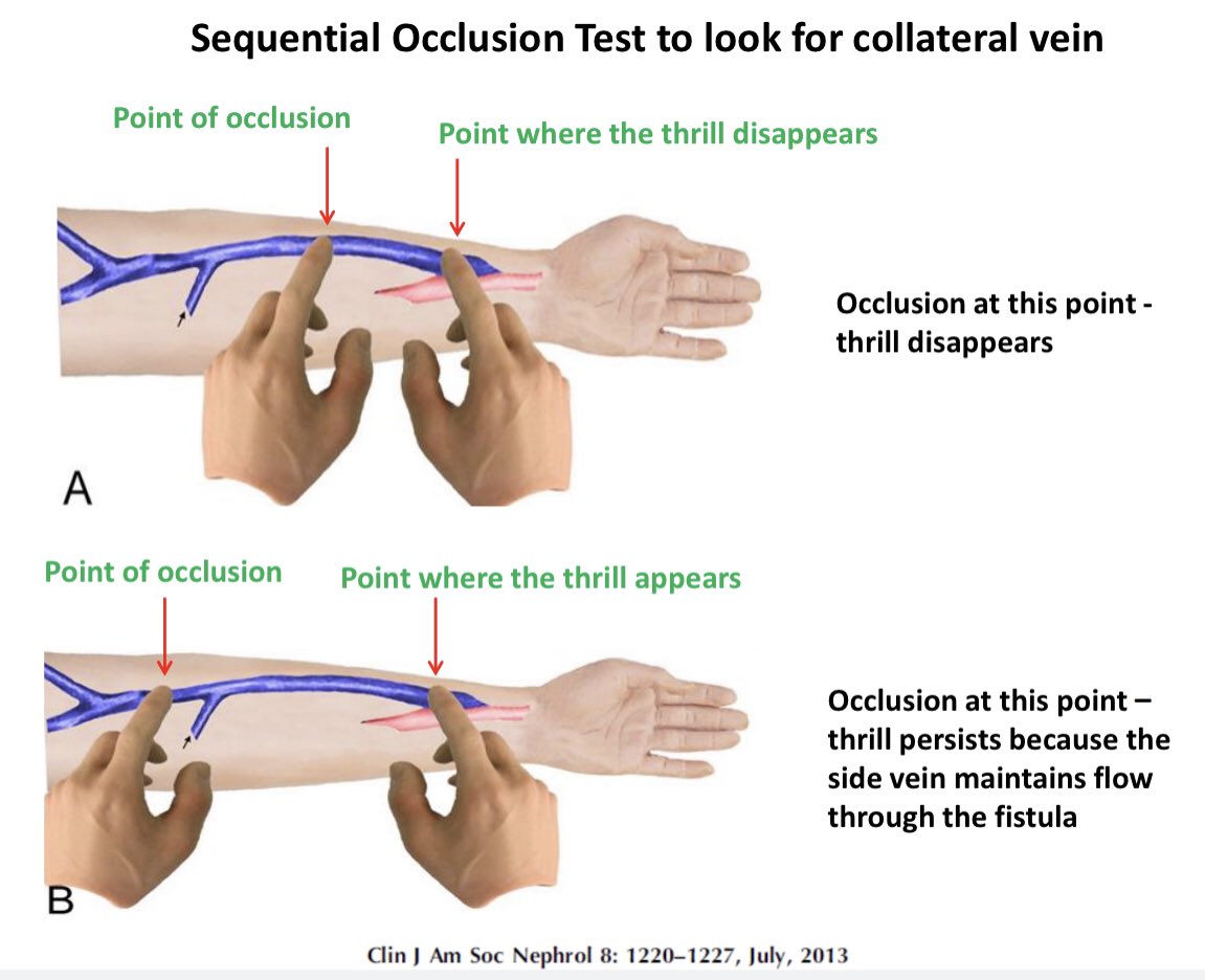 💥’Physical Examination of the Dialysis Vascular Access’ - Tweetorial ...