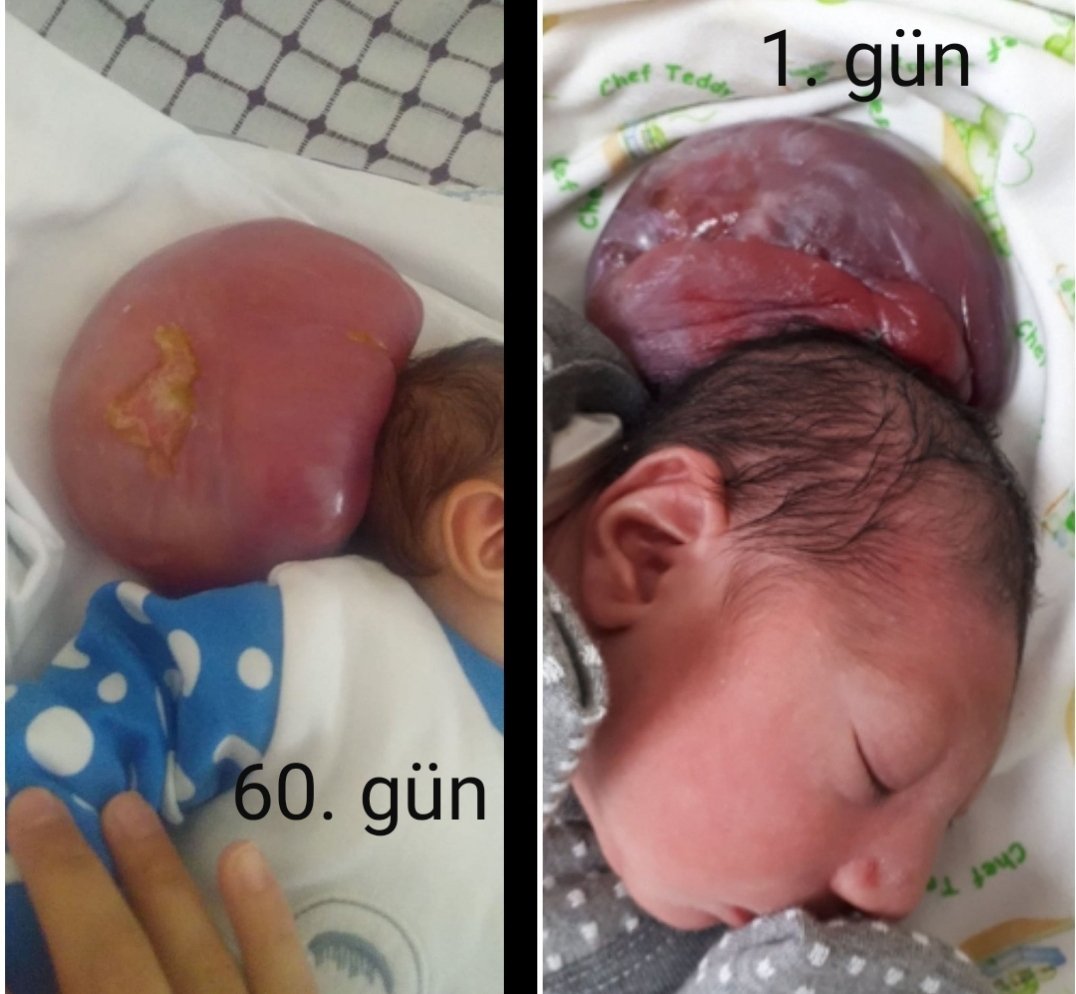 Bu aileye ulaşan arkadaşlar.Elif bebeğin beyin cerrahisi Dr İbrahim Alataşa ulaşmalarını sağlayalım.Bu bebeğimiz spina bifida ve hidro sefali hastası. Yer: Şişli florance hastahanesi.Bu hastalığın en iyi doktoru orda,aynı zamanda bu hastalara ücretsiz tedavi hizmeti de verilmekte