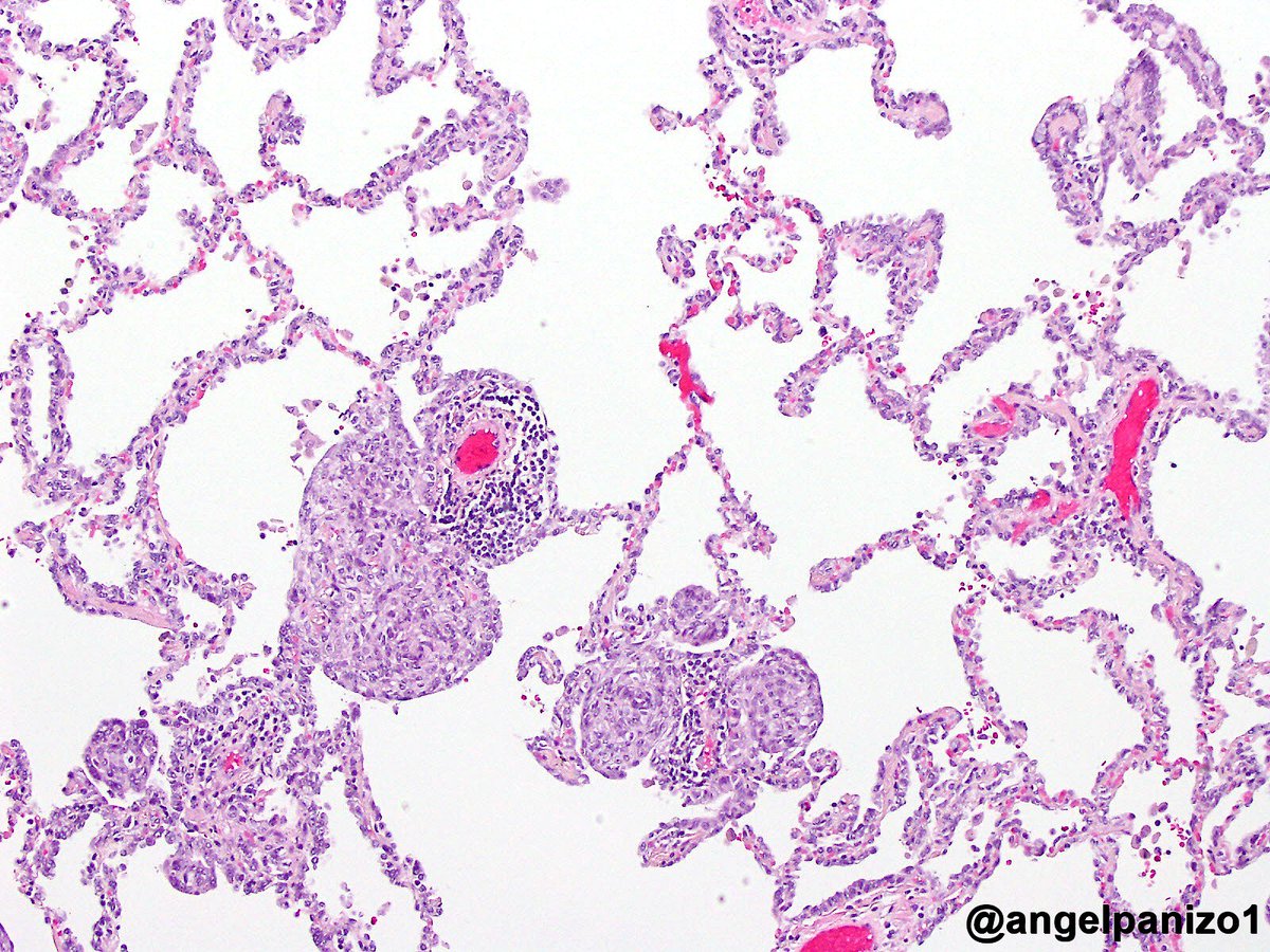 angelpanizo1's tweet photo. More pictures of these nodular CK7 &amp; TTF1 positive strucures. Vascular markers CD34 &amp; CD31 negative (no vascular invasion) #pulmpath #pathol @smlungpathguy @yro854 @lara_pijuan @SansanoValero @kis_lorand @tralimiguel https://t.co/sj9r8x4THw