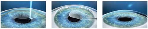 DRVLPSC_eye's tweet photo. #ReLExSMILE represents the beginning of a new era in refractive surgery. #zeiss #Visumax
#ReLExSMILE
#FlaplessBladeless #LASIK First in Rajasthan since 2012.
#DrVirendraAgrawal
#JAIPUR https://t.co/fBC9NWO31N