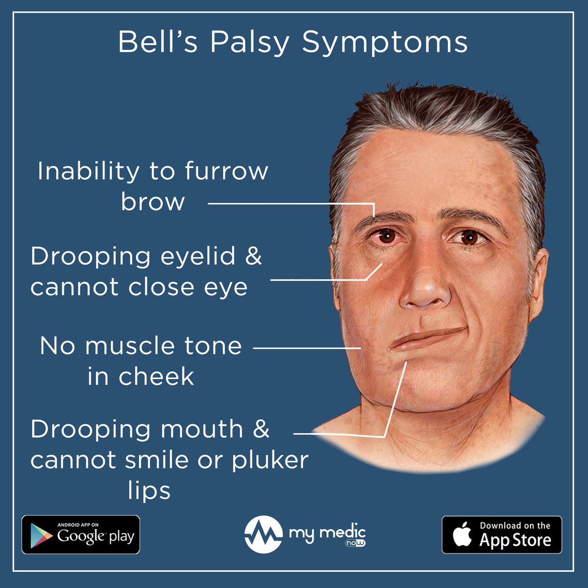 Bell's palsy is a condition in which the muscles on one side of your face become weak or paralyzedFind the best doctor near you on mymedicnow. Download 
 #BellsPalsy #Symptoms #Health #HealthierLife #Hospital #Dubai #UAE #AbuDhabi #DubaiClinics #Healthtip #OnlineAppointment