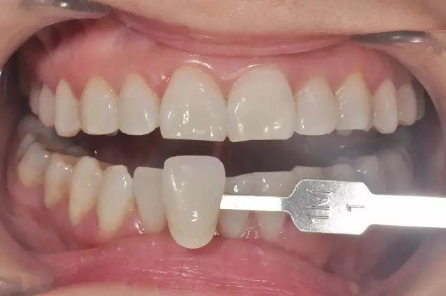 Veneer