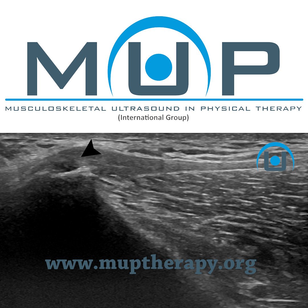 muptherapy's tweet photo. Tendinopatía de inserción proximal del glúteo medio. Un ejemplo claro del por qué hay que ir más allá de las exploraciones esenciales. https://t.co/mn9brCOdF2