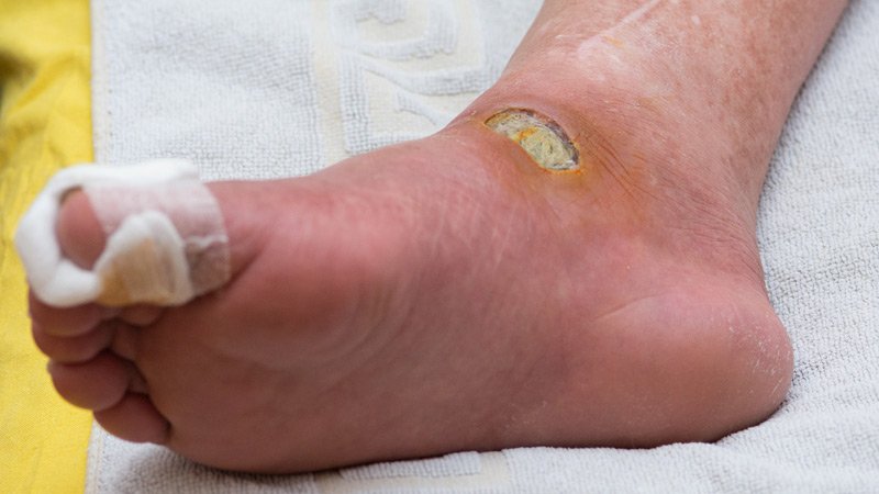 Website: woundcaremeet.ml
Guidelines for Diabetic Foot Care: A Template for the Care of All Feet
#diabeticfootulcer #DiabeticWoundCare #TissueRepair #WoundHealing #WoundCare #SkinDiseasesEducation #LaserTechnologies #diabeticfoot