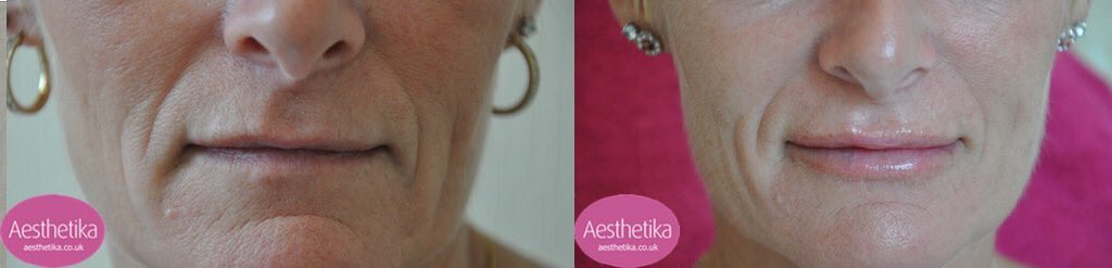 aesthetika's tweet photo. A combination of #fillers to the #lowerface have been used here to enhance and expand the soft tissues providing a #natural looking appearance https://t.co/PjRdTJBx9X