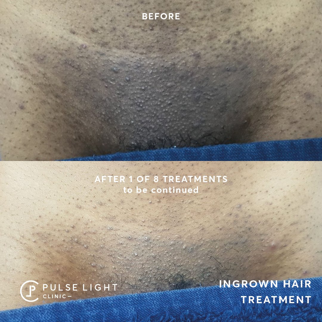 Pulse Light Clinic on Twitter: Pulse Light Clinic on Twitter: