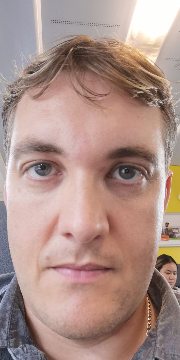 Sehe aus wie ein Klingone. Allergische Reaktion von Stich. Hehe
