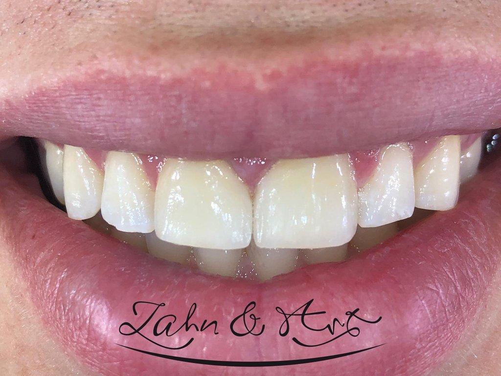 ZahnundArt's tweet photo. Dieser Patient hatte als Kind ein #Frontzahntrauma. Somit bekam er von uns #Veneers. Diese Behandlung erfolgte innerhalb von einem Tag und dauerte ungefähr 3 Stunden. https://t.co/7GoYDoEKNE