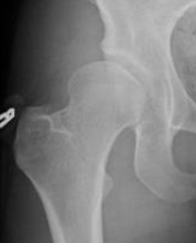 StephaniePunMD's tweet photo. More severe dysplasia usually causes pain/dysfunction at a younger age and is diagnosed earlier, whereas milder dysplasia may take decades for enough cumulative hip joint damage to cause pain. @IHDIonline @Stanford_Ortho @StanfordChild @StanfordHealth https://t.co/QIlDU9bkYw