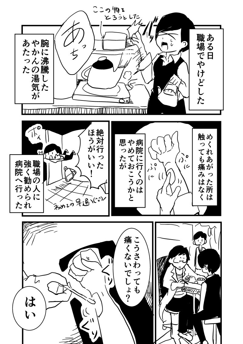 無痛のやけどは病院に行ったほうがいい。
#エッセイ漫画 #漫画 