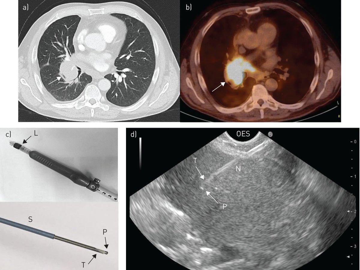 ERSpublications's tweet photo. Real-time lung cancer detection by endosonography-guided nCLE is feasible and safe. nCLE lung cancer characteristics are accurately recognised. nCLE might become a useful adjunct to bronchoscopy for real-time identification of lung tumours. https://t.co/nvJP77r8gX https://t.co/prlBcLQaaY