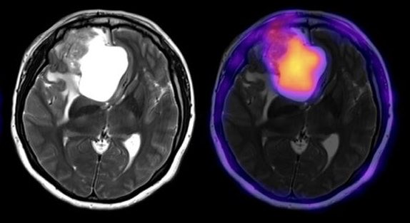 El día de ayer se firma el convenio de prestaciones de servicios médicos de PET/CTentre <a href="/incanMX/">Instituto Nacional de Cancerología</a> México y el Hospital de Oncologia del Centro Médico Nacional Siglo XXI del IMSS <a href="/Tu_IMSS/">IMSS </a> . Hecho sin precedente en beneficio del paciente Oncológico.