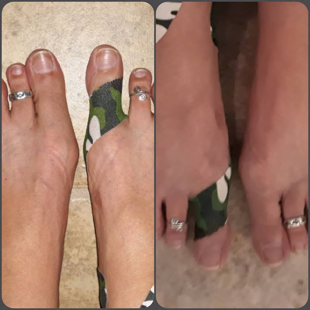 MassageSummit's tweet photo. Kinesiotaping for positional bunion. #RockTape #kinesiotaping #nonsurgical #painrelief  @Rocktape https://t.co/gvBM9DsVpS