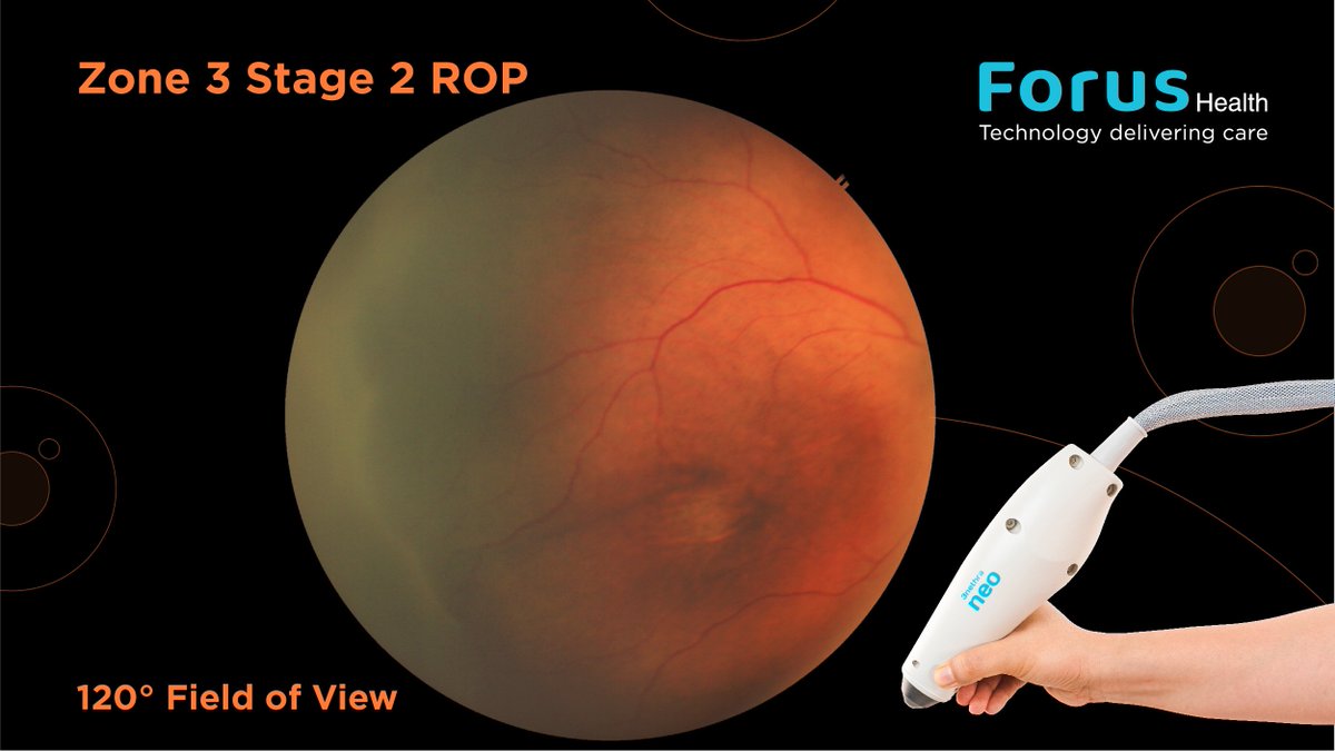 forus_health's tweet photo. The #3nethra neo, a high-resolution #widefieldimaging system, has the capability to provide a 120° field of view, providing accurate visualization of the peripheral #retina. This is vital for the early detection, treatment, and management of #ROP in #prematurebabies. https://t.co/yyVfBDGka6