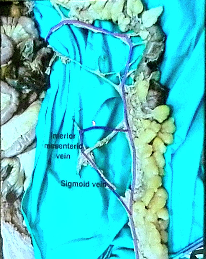 Gianluca Pellino (@gianlucapellino) on Twitter photo Álvaro García-Granero presenting the "Garcia Granero's venous trunk" theory
when should you ligate the IMV in order to optimise venous drainage of a colorectal anastomosis?
...stay tuned for the full description <a href="/TechColoproctol/">Techniques in Coloproctology Journal</a>
#colorectalsurgery #colorectalresearch Álvaro García-Granero presenting the "Garcia Granero's venous trunk" theory
when should you ligate the IMV in order to optimise venous drainage of a colorectal anastomosis?
...stay tuned for the full description <a href="/TechColoproctol/">Techniques in Coloproctology Journal</a>
#colorectalsurgery #colorectalresearch