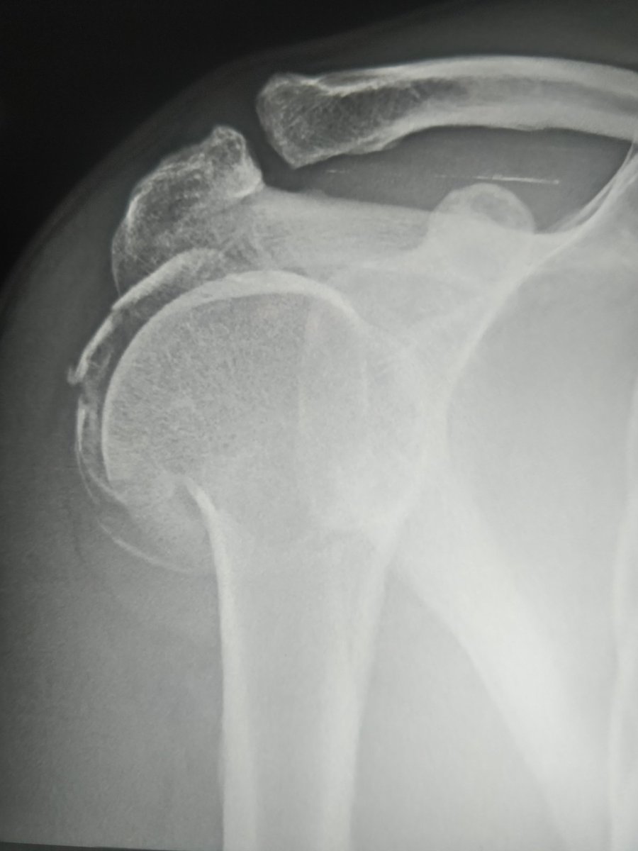 RamanathSharath's tweet photo. 3 part fracture proximal Humerus , with comminuted greater tuberosity fixed with PHILOS .. anatomical reduction achieved. 
#shouldersurgery
#fracturefixation 
#fracturesurgery https://t.co/RZ4IV6uVgK
